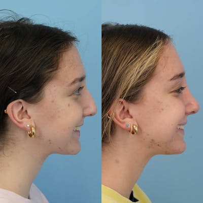 Rhinoplasty Before & After Gallery - Patient 444274 - Image 6