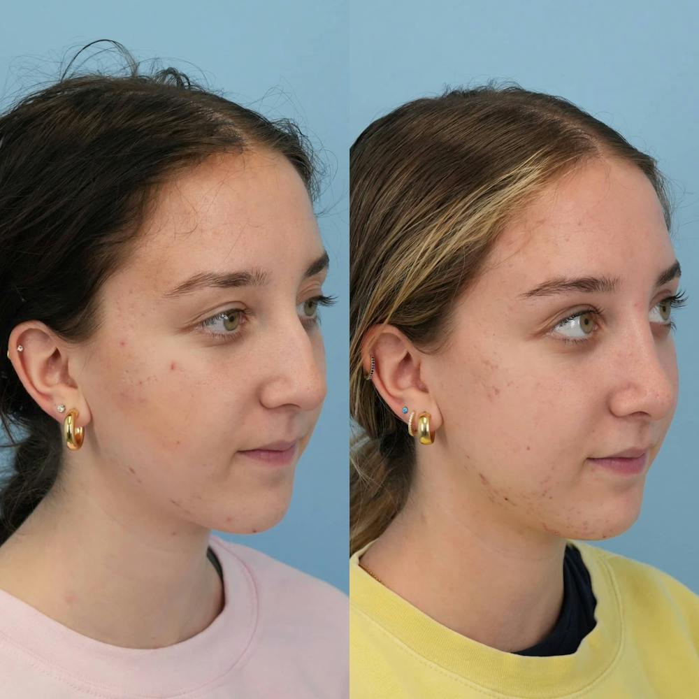 Rhinoplasty Before & After Gallery - Patient 444274 - Image 7