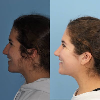 Rhinoplasty Before & After Gallery - Patient 718061 - Image 2
