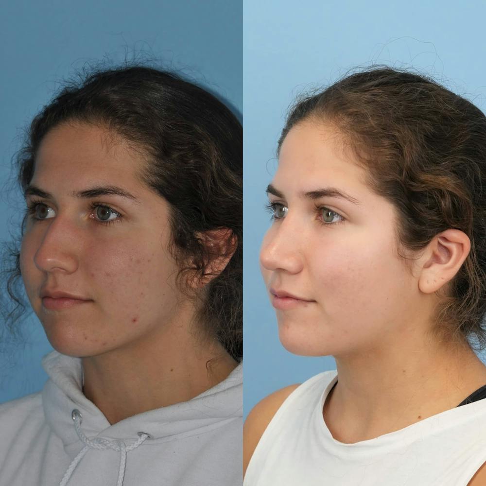 Rhinoplasty Before & After Gallery - Patient 718061 - Image 3