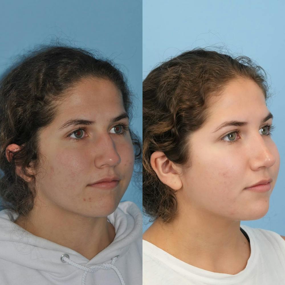 Rhinoplasty Before & After Gallery - Patient 718061 - Image 5