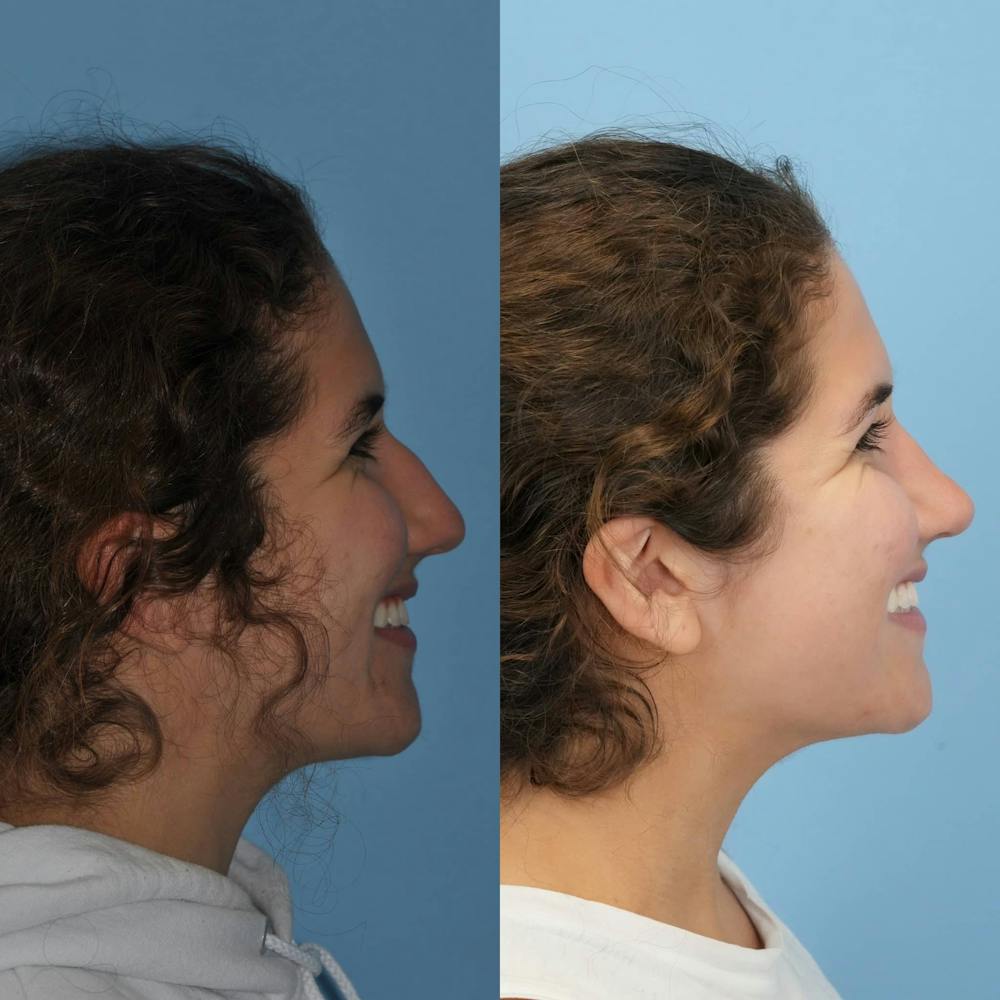 Rhinoplasty Before & After Gallery - Patient 718061 - Image 6