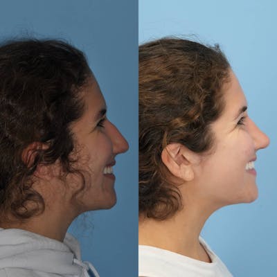 Rhinoplasty Before & After Gallery - Patient 718061 - Image 6