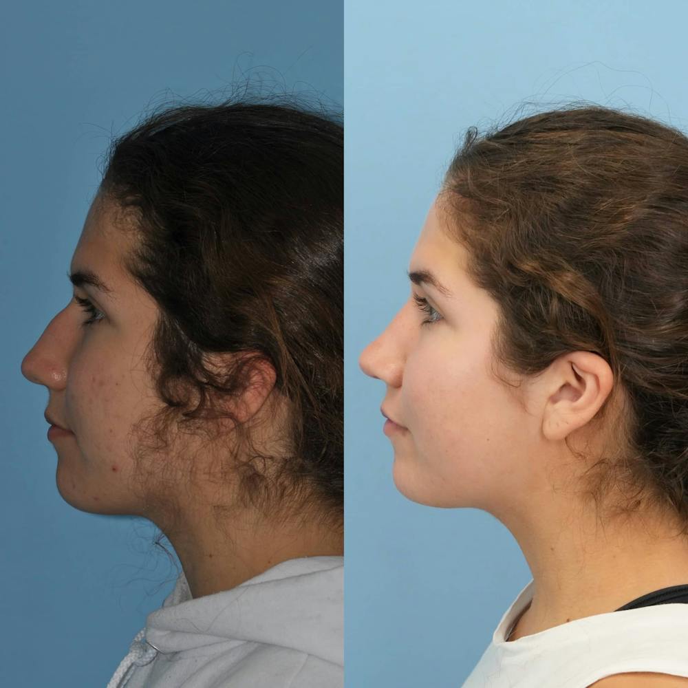 Rhinoplasty Before & After Gallery - Patient 718061 - Image 7