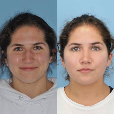 Rhinoplasty Before & After Gallery - Patient 718061 - Image 1