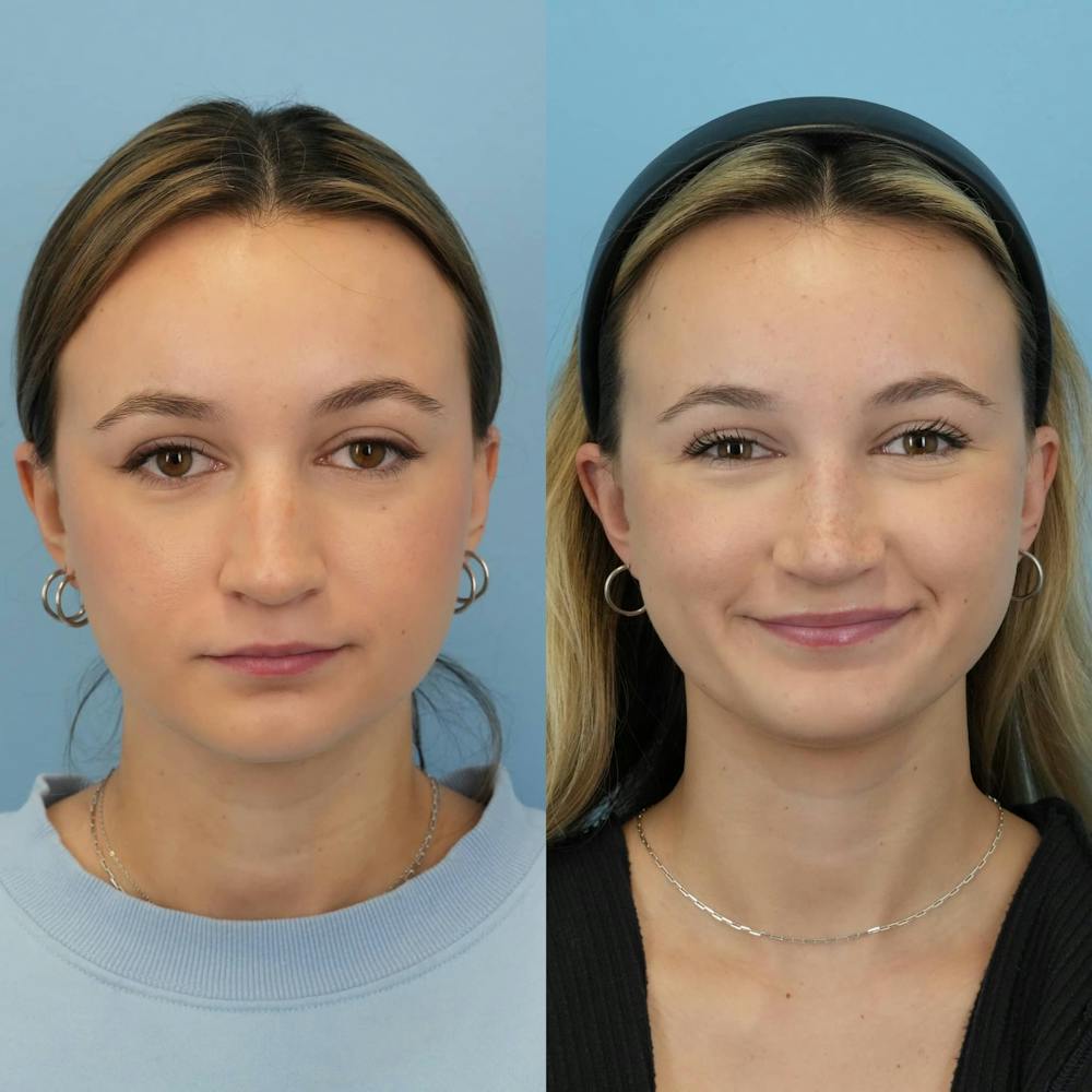 Rhinoplasty Before & After Gallery - Patient 372436 - Image 1