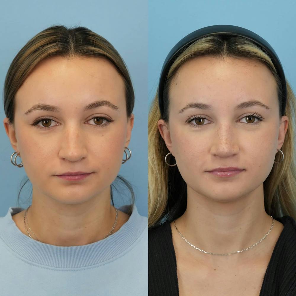 Rhinoplasty Before & After Gallery - Patient 372436 - Image 2