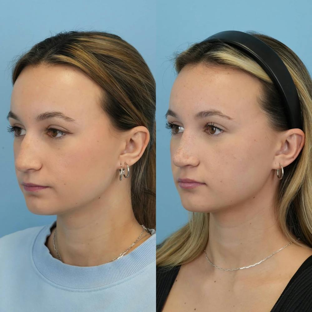 Rhinoplasty Before & After Gallery - Patient 372436 - Image 3