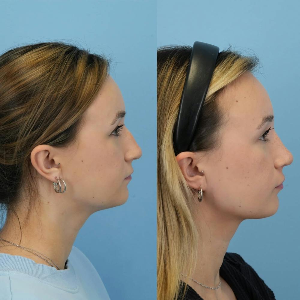 Rhinoplasty Before & After Gallery - Patient 372436 - Image 4