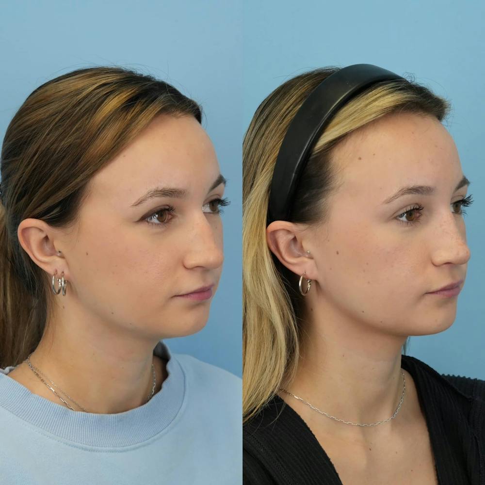 Rhinoplasty Before & After Gallery - Patient 372436 - Image 5