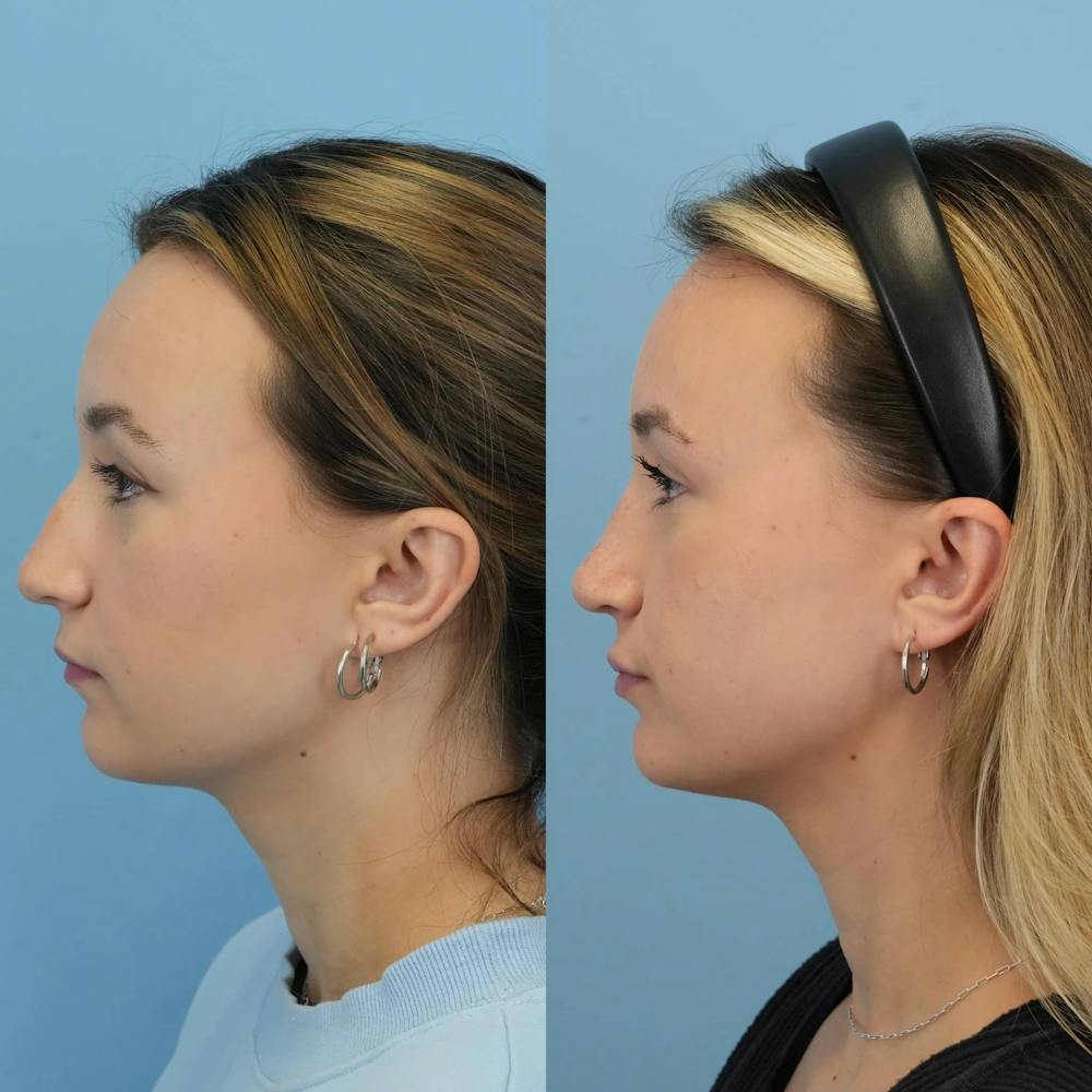 Rhinoplasty Before & After Gallery - Patient 372436 - Image 6