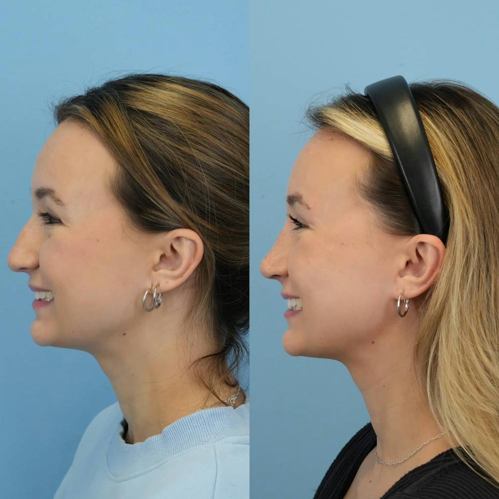 Rhinoplasty Before & After Gallery - Patient 372436 - Image 7