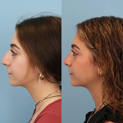 Rhinoplasty Before & After Gallery - Patient 291529 - Image 2