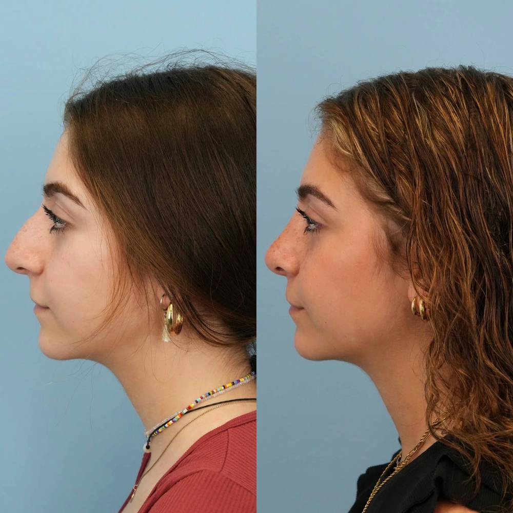 Rhinoplasty Before & After Gallery - Patient 291529 - Image 2