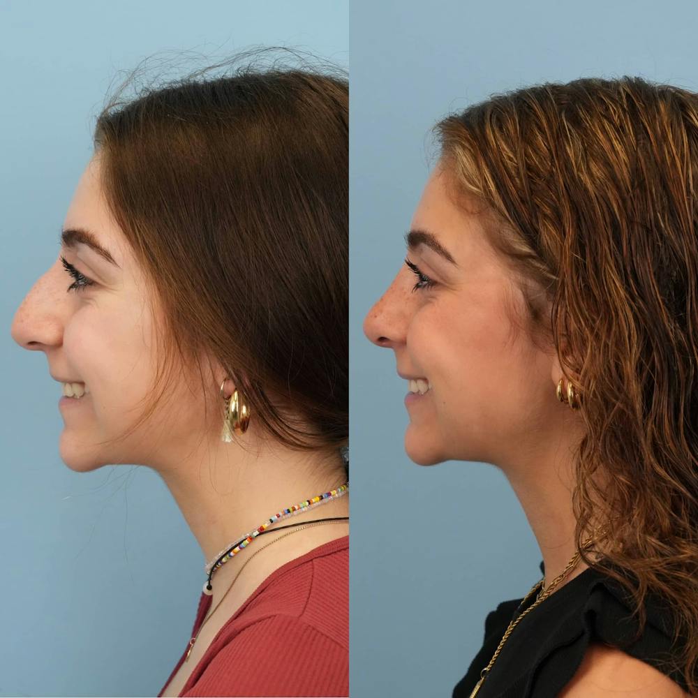 Rhinoplasty Before & After Gallery - Patient 291529 - Image 3