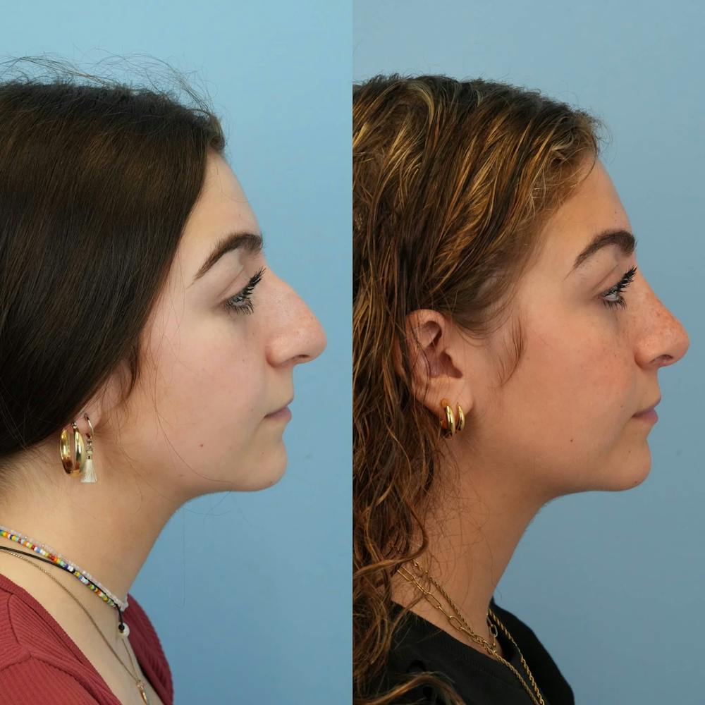 Rhinoplasty Before & After Gallery - Patient 291529 - Image 5