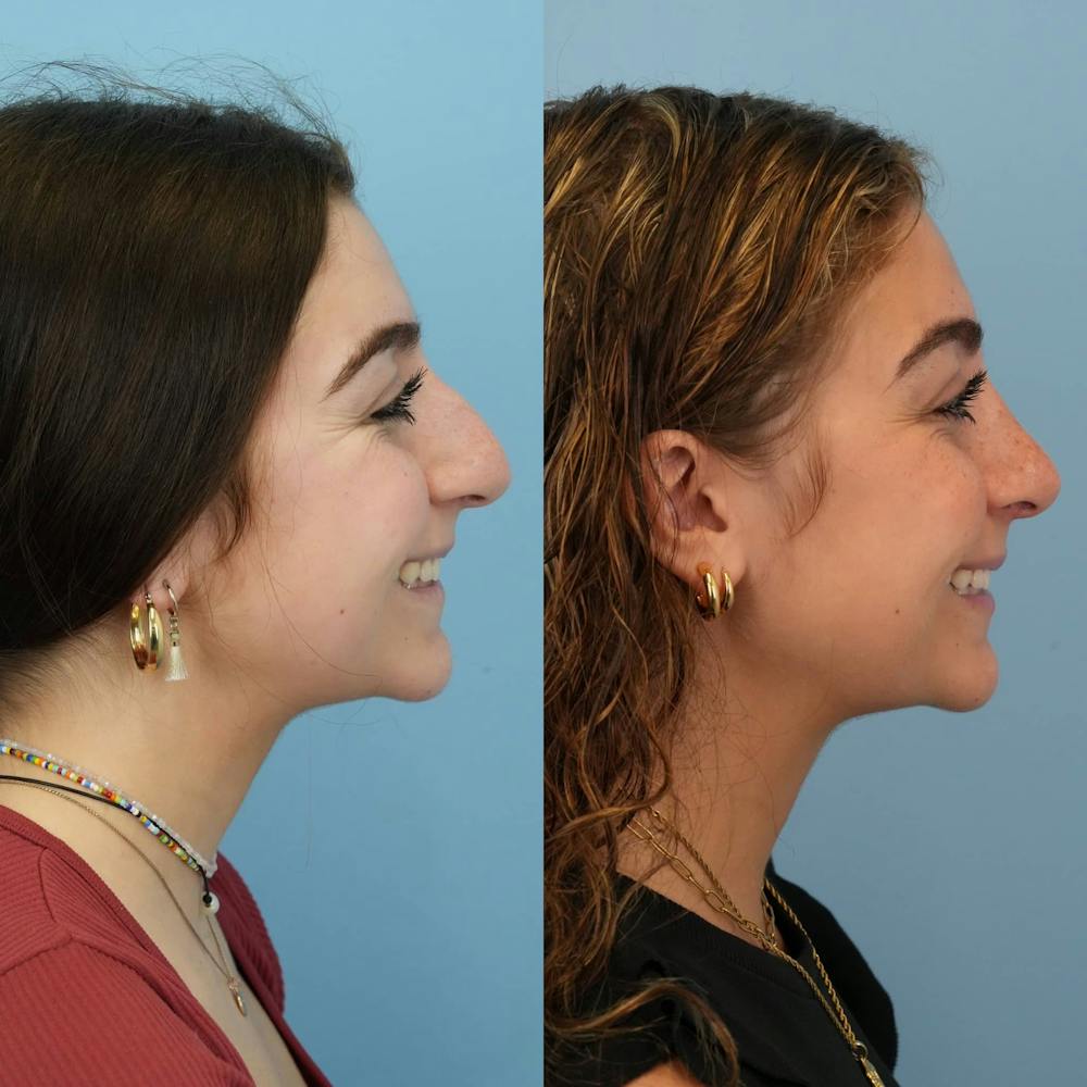 Rhinoplasty Before & After Gallery - Patient 291529 - Image 7