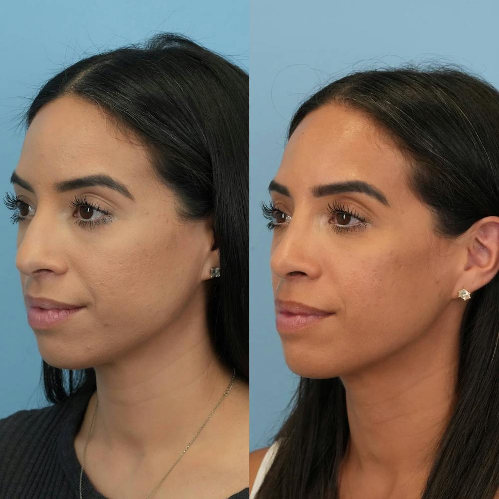 Rhinoplasty Before & After Gallery - Patient 269178 - Image 5