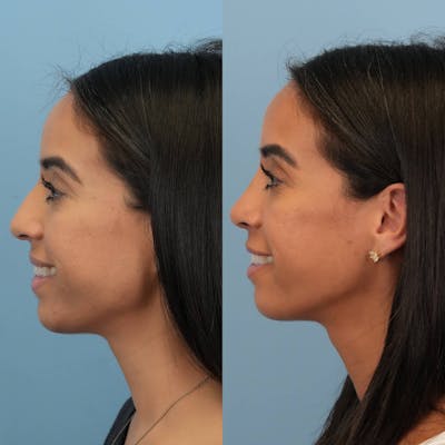 Rhinoplasty Before & After Gallery - Patient 269178 - Image 6