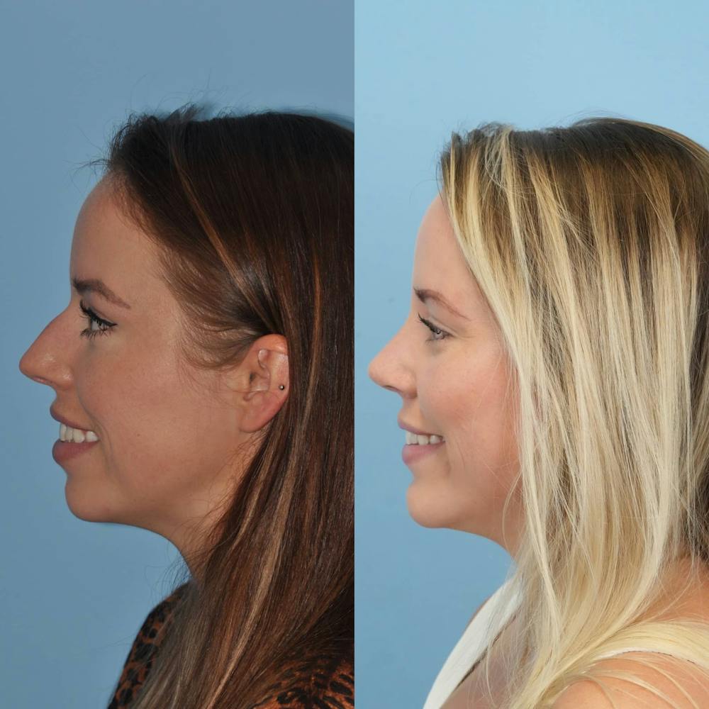 Rhinoplasty Before & After Gallery - Patient 797233 - Image 2