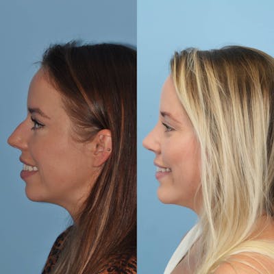 Rhinoplasty Before & After Gallery - Patient 797233 - Image 2