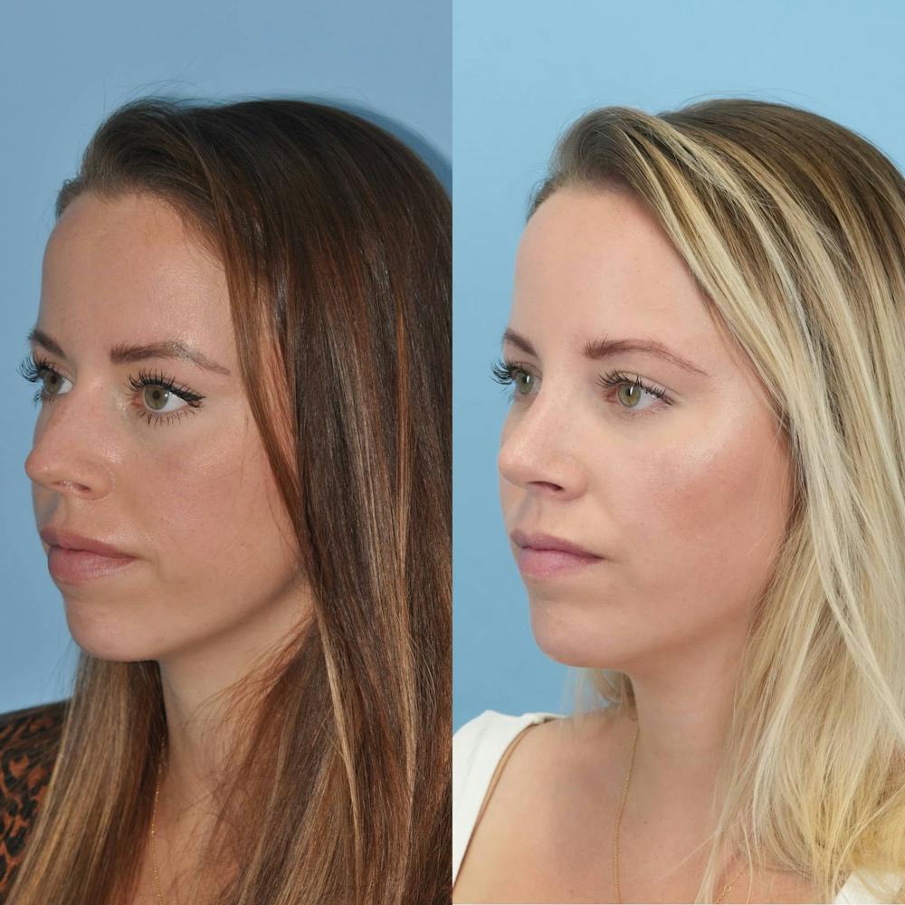 Rhinoplasty Before & After Gallery - Patient 797233 - Image 3