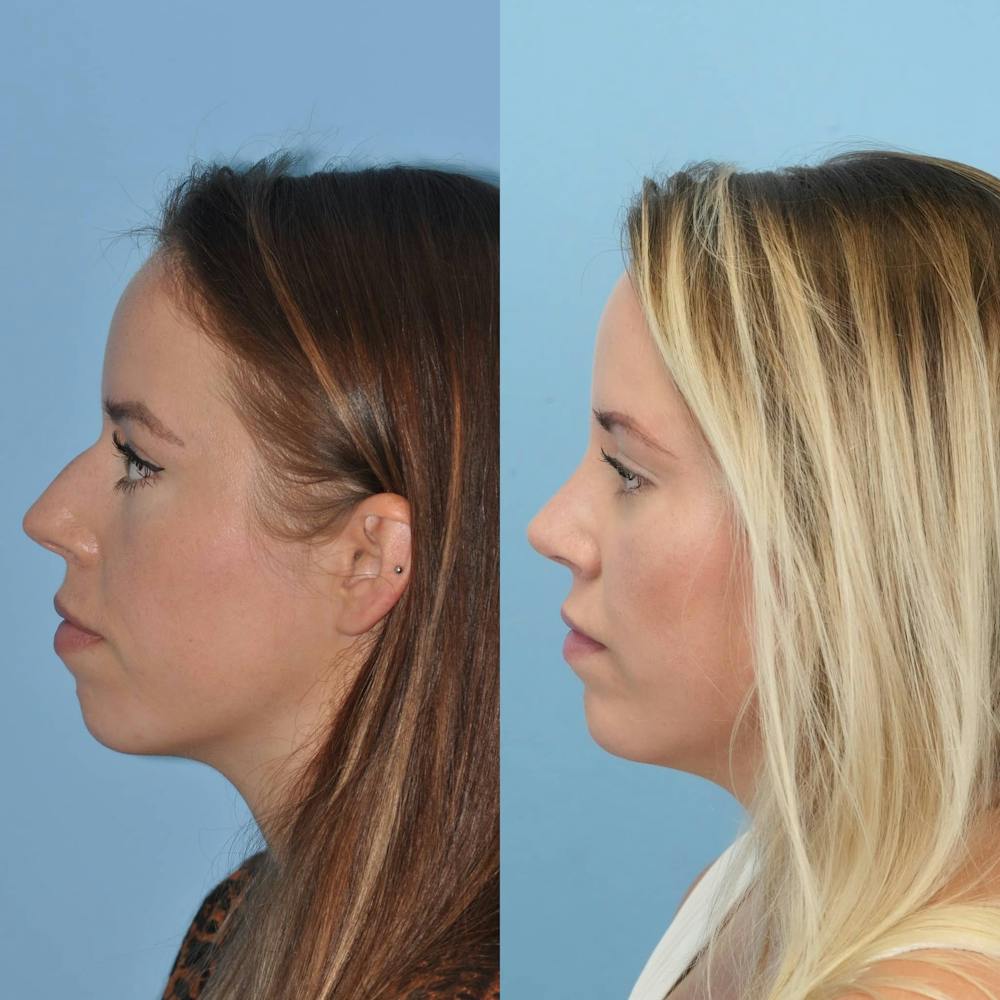 Rhinoplasty Before & After Gallery - Patient 797233 - Image 4