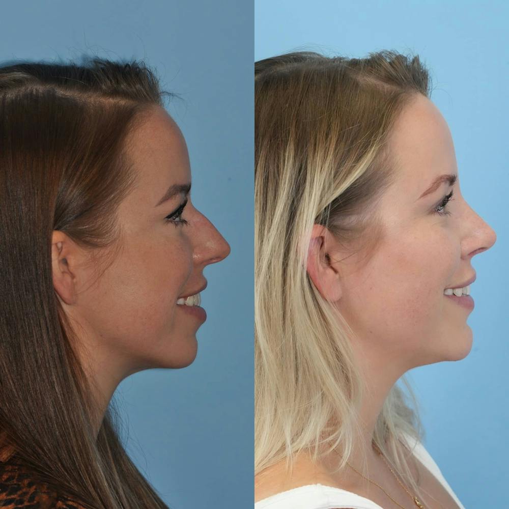 Rhinoplasty Before & After Gallery - Patient 797233 - Image 5