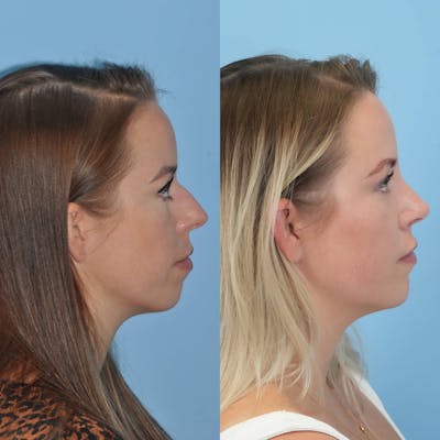 Rhinoplasty Before & After Gallery - Patient 797233 - Image 6