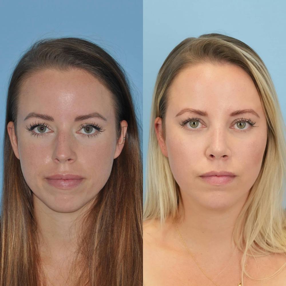 Rhinoplasty Before & After Gallery - Patient 797233 - Image 1