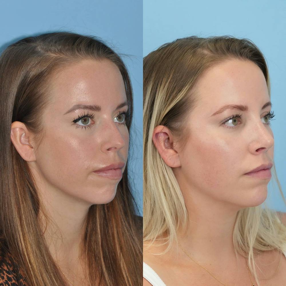 Rhinoplasty Before & After Gallery - Patient 797233 - Image 7