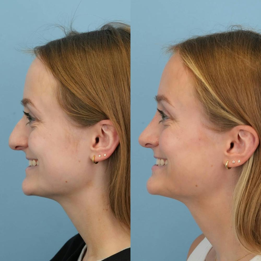 Rhinoplasty Before & After Gallery - Patient 154823 - Image 2