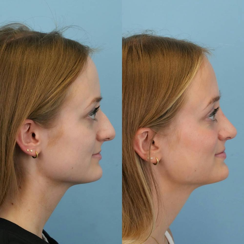 Rhinoplasty Before & After Gallery - Patient 154823 - Image 3