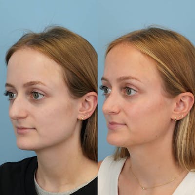 Rhinoplasty Before & After Gallery - Patient 154823 - Image 4