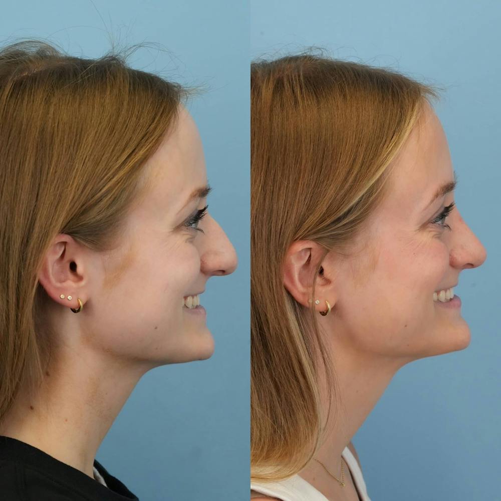 Rhinoplasty Before & After Gallery - Patient 154823 - Image 5
