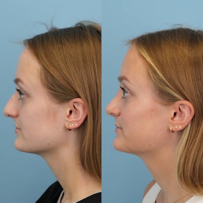 Rhinoplasty Before & After Gallery - Patient 154823 - Image 6