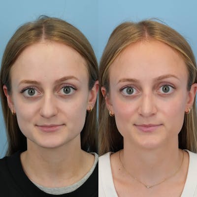 Rhinoplasty Before & After Gallery - Patient 154823 - Image 1