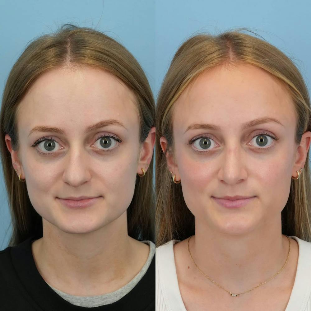 Rhinoplasty Before & After Gallery - Patient 154823 - Image 1