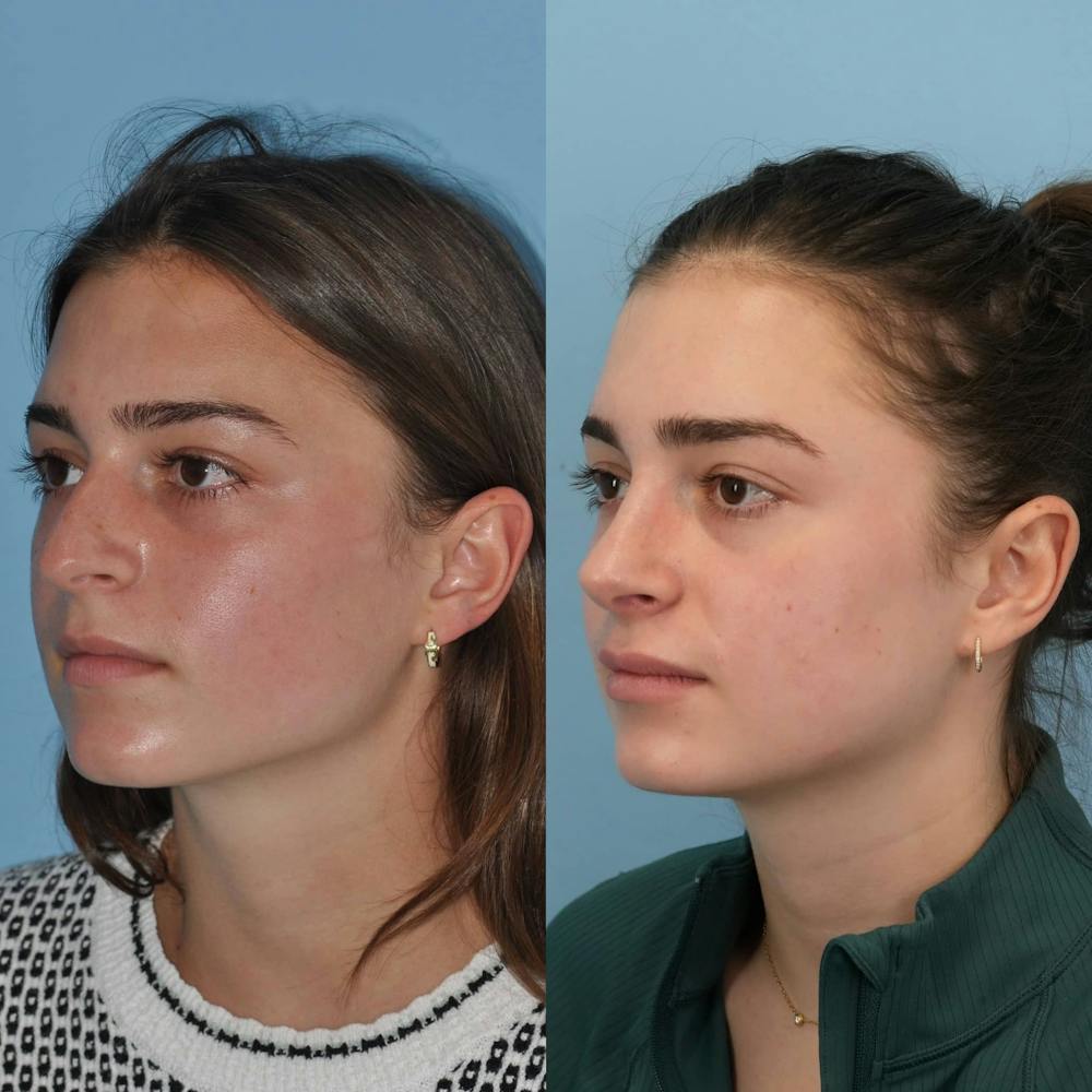 Rhinoplasty Before & After Gallery - Patient 125331 - Image 3