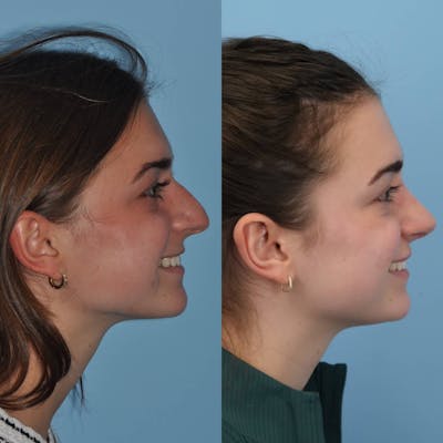 Rhinoplasty Before & After Gallery - Patient 125331 - Image 4
