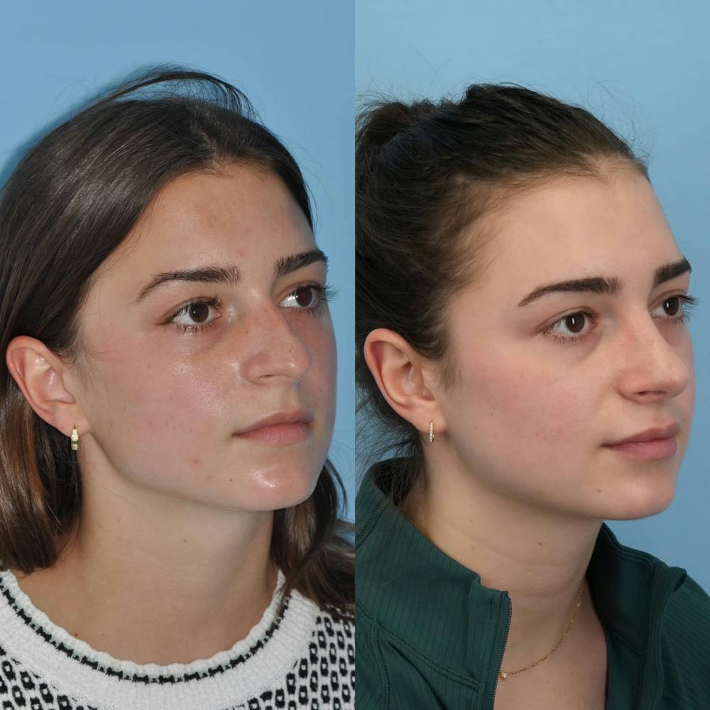 Rhinoplasty Before & After Gallery - Patient 125331 - Image 6