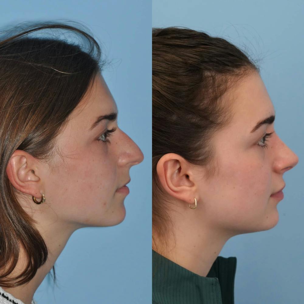 Rhinoplasty Before & After Gallery - Patient 125331 - Image 5