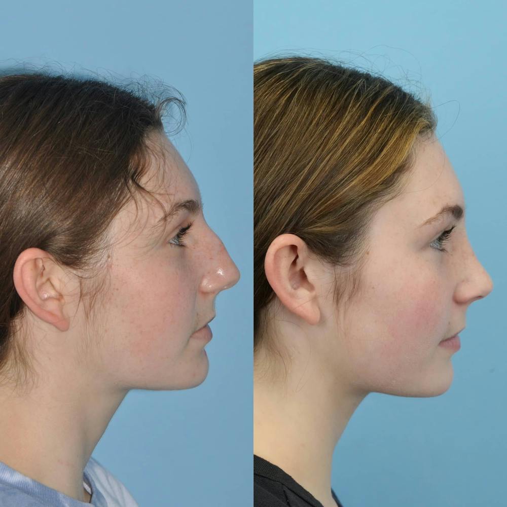 Rhinoplasty Before & After Gallery - Patient 346964 - Image 3