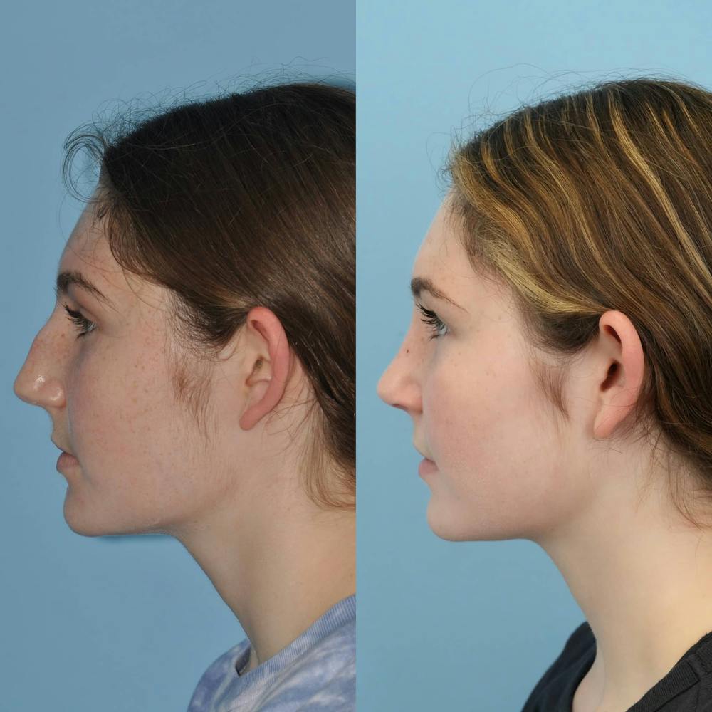 Rhinoplasty Before & After Gallery - Patient 346964 - Image 6