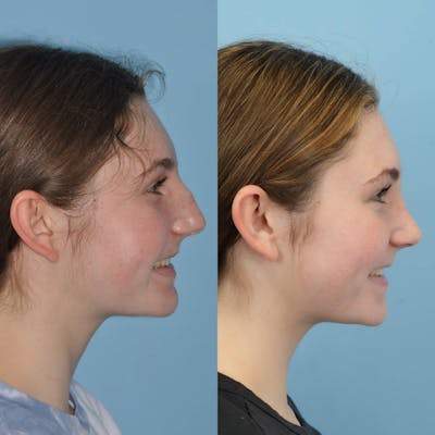 Rhinoplasty Before & After Gallery - Patient 346964 - Image 2