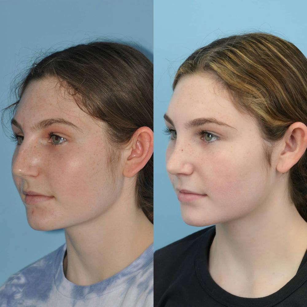 Rhinoplasty Before & After Gallery - Patient 346964 - Image 5