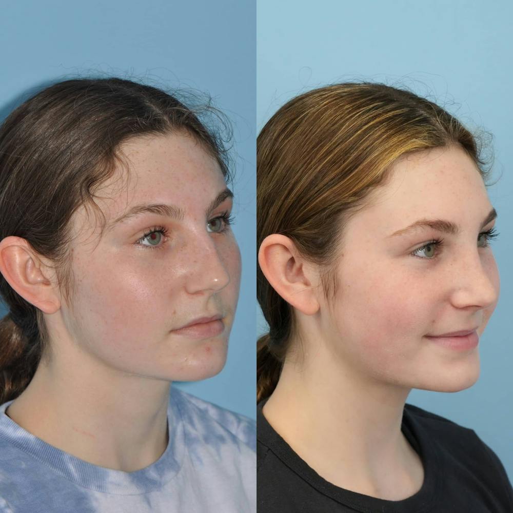 Rhinoplasty Before & After Gallery - Patient 346964 - Image 4