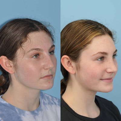 Rhinoplasty Before & After Gallery - Patient 346964 - Image 4