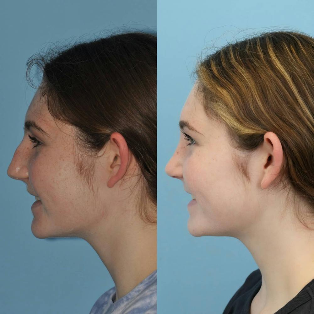 Rhinoplasty Before & After Gallery - Patient 346964 - Image 7