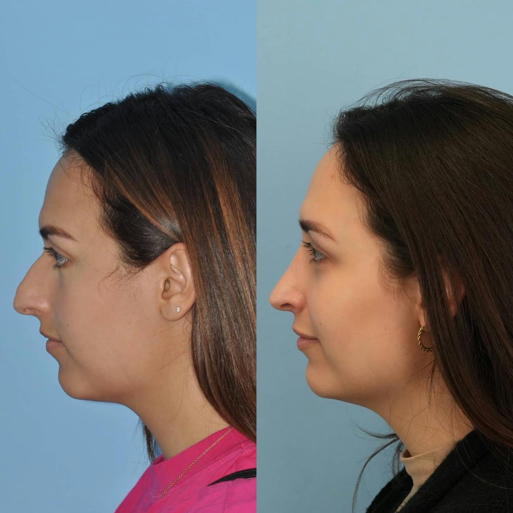 Rhinoplasty Before & After Gallery - Patient 201850 - Image 3
